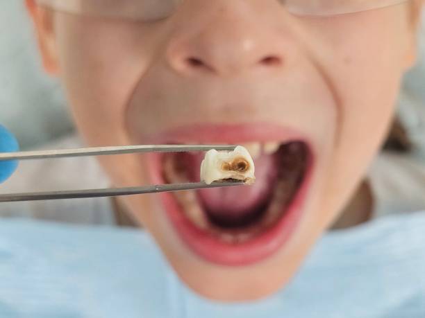 Best Emergency Tooth Extraction in Fifth Street, TX